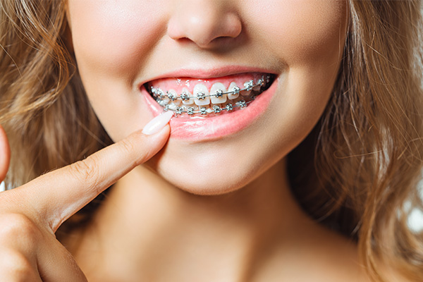 Img post Ortodoncia: dientes alineados, sonrisa perfecta